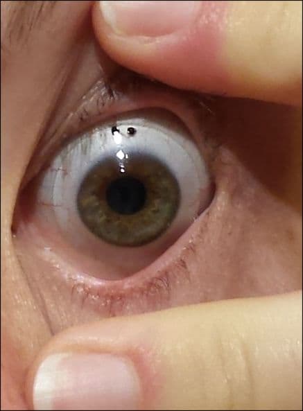 Scleral_lens_worn_on_an_eye.jpg